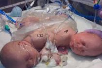 conjoined-twins-carter-and-conner-mirabal