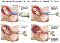 dismemberment-abortion